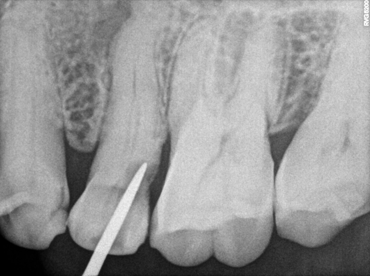 Dental X-ray